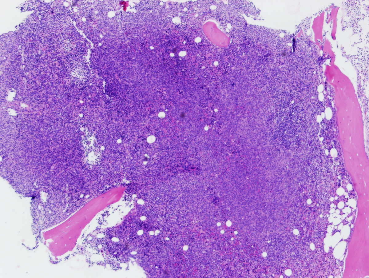 BM biopsy